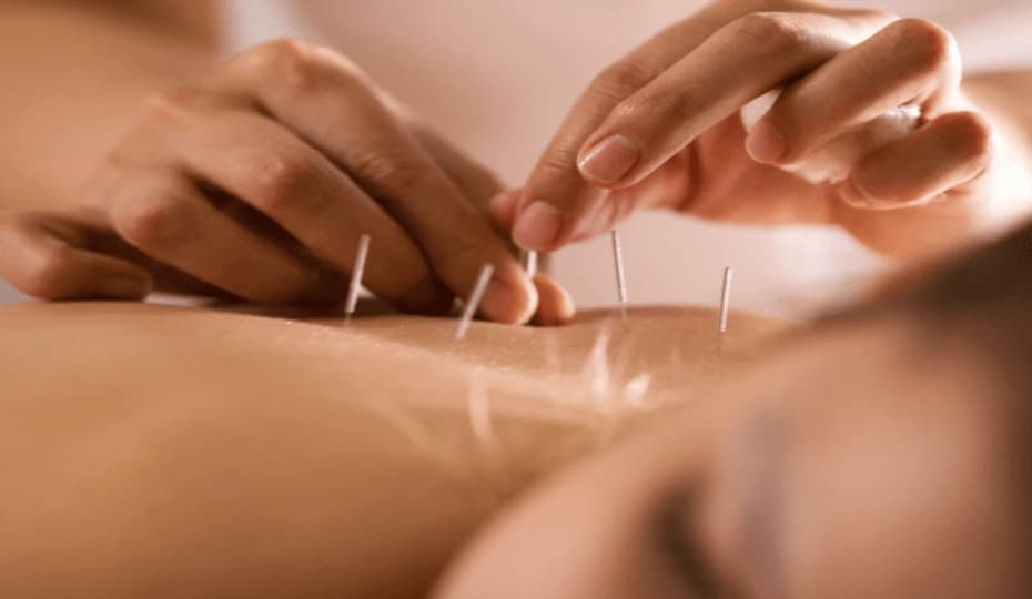 Acupuncture for natural healing and wellness at VSR Vriksha naturopathy wellness centre in Hyderabad
